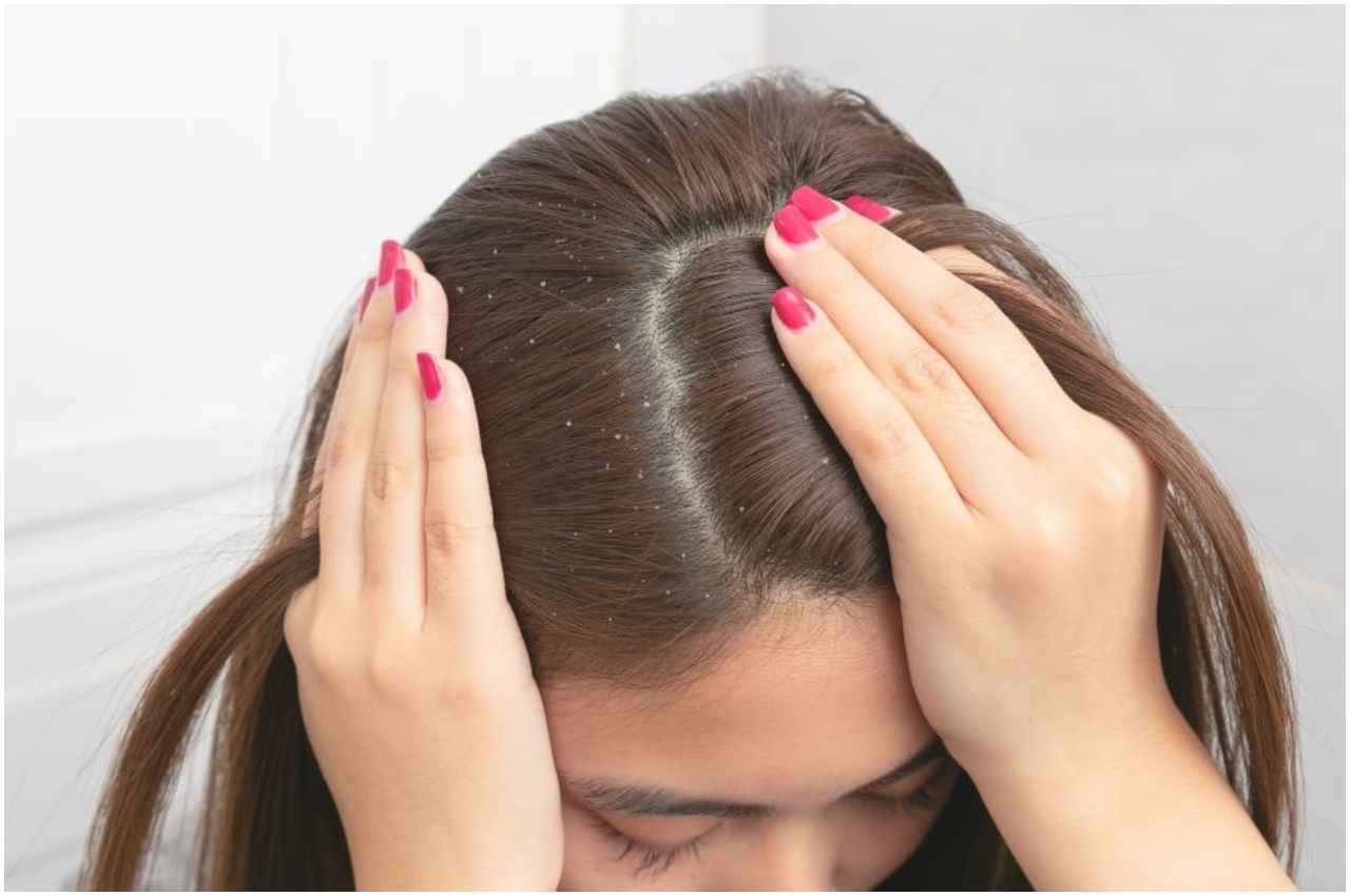Cause of Dandruff In Hair: इन 5 गलतियों से बालों में भर जाते हैं डैंड्रफ, कहीं आप तो नहीं कर रहे....