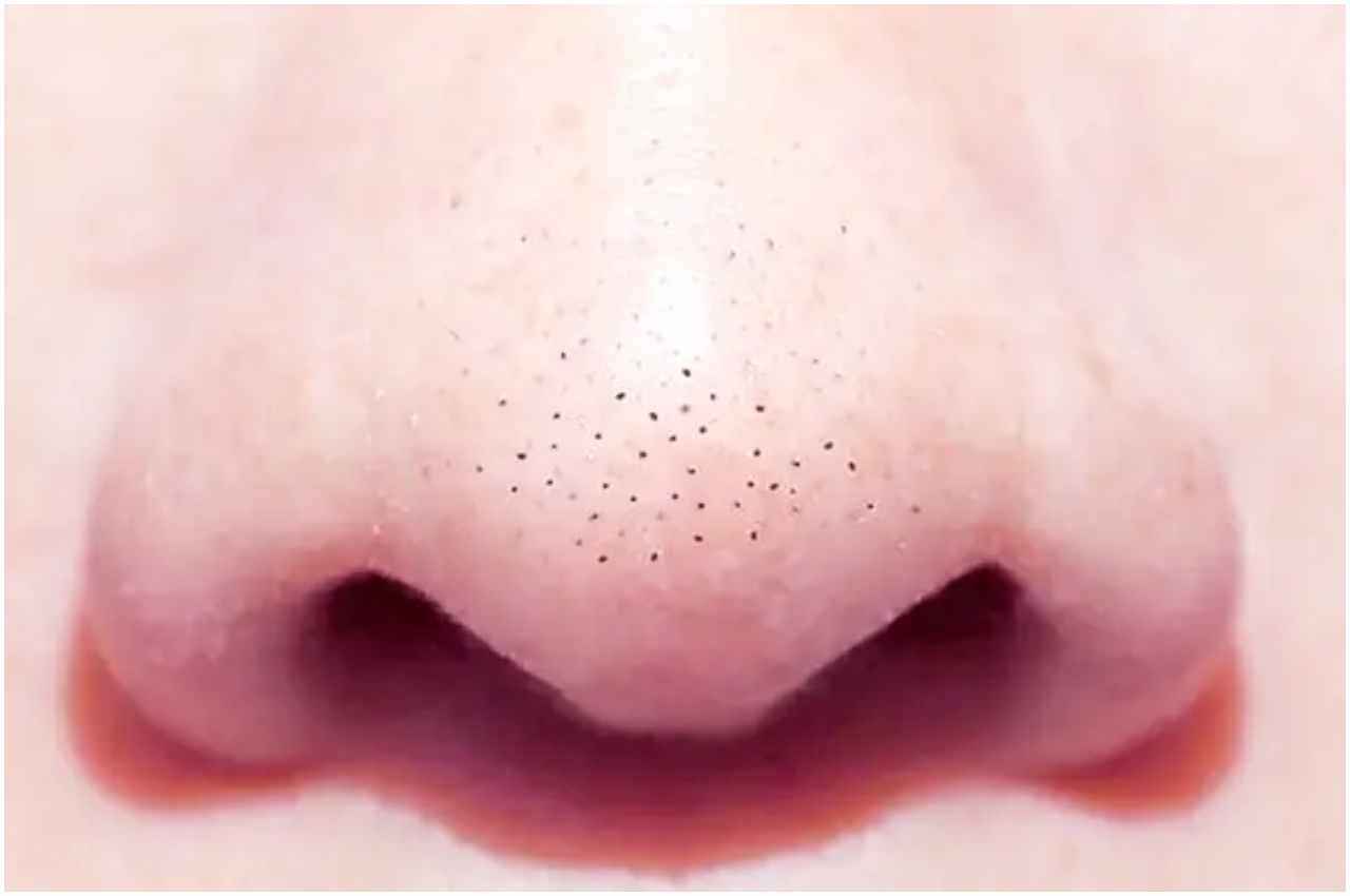 Home Remedies For Removing Black Heads: इन घरेलू उपायों से रातों-रात गायब हो जाएंगे जिद्दी ब्‍लैकहैड्स, यकीन न हो तो ट्राई करके देखें
