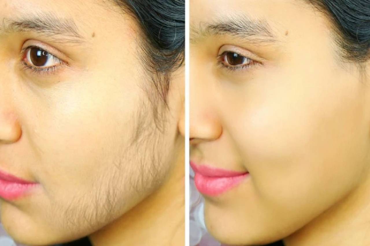 Face Hair Removal how to remove facial hair Chehre ke baal kaise hataye