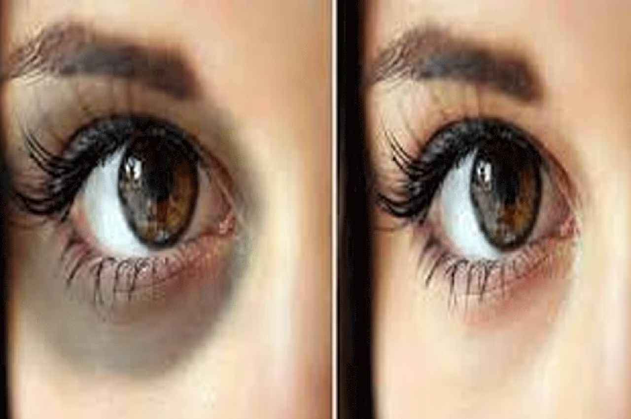 Dark Circles Remove: ये चीज हमेशा के लिए हटा देगी काले घेरे...बेहद सस्ती और फायदेमंद, रात में करें यूज