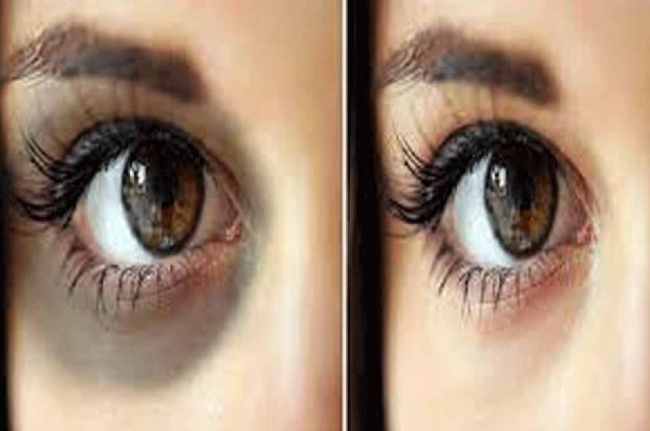 Dark Circles Remove with banana peel how to remove dark circles