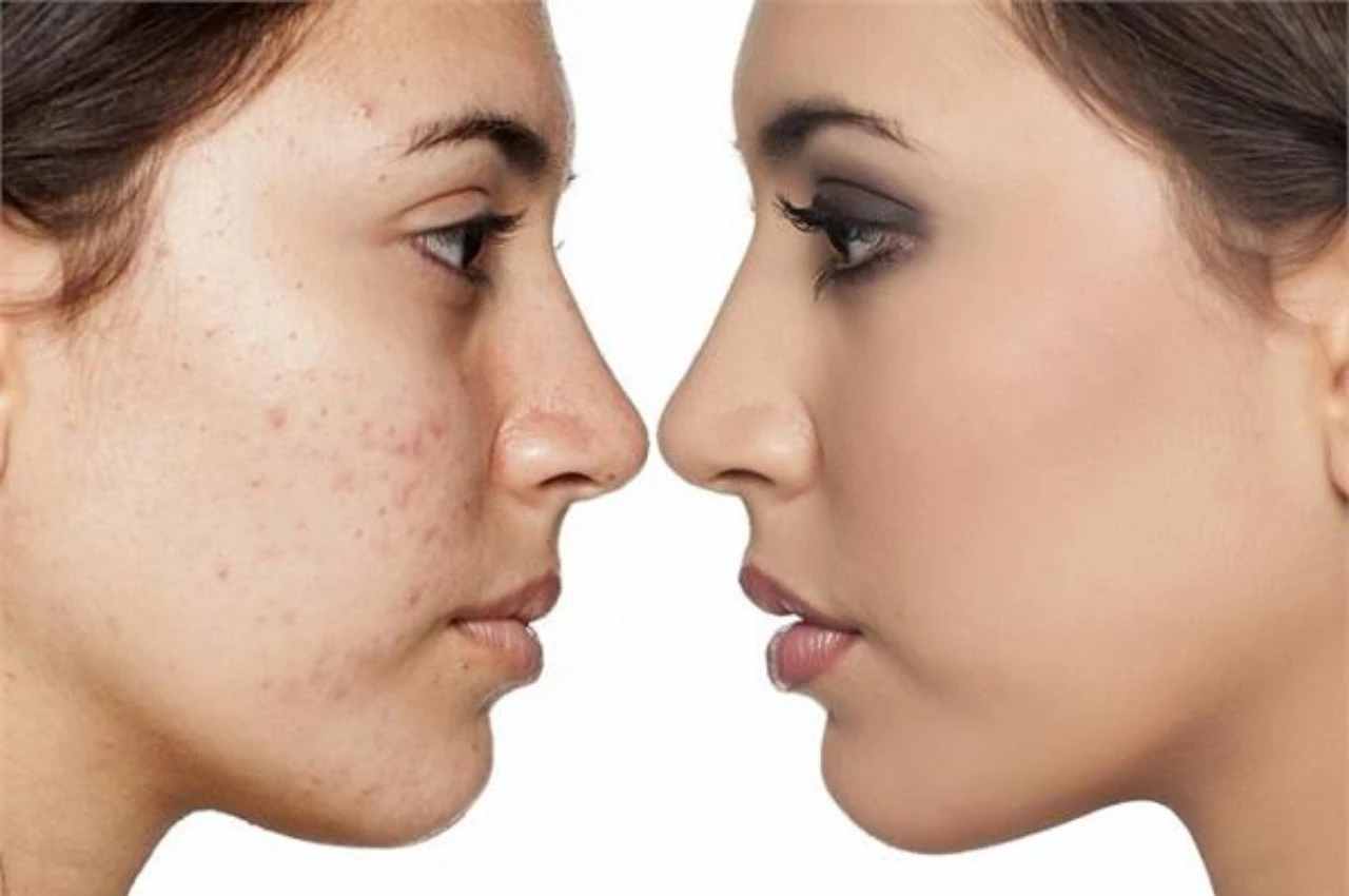 Skin Care TIPS Remove pimples with figs gora hone ka tarika