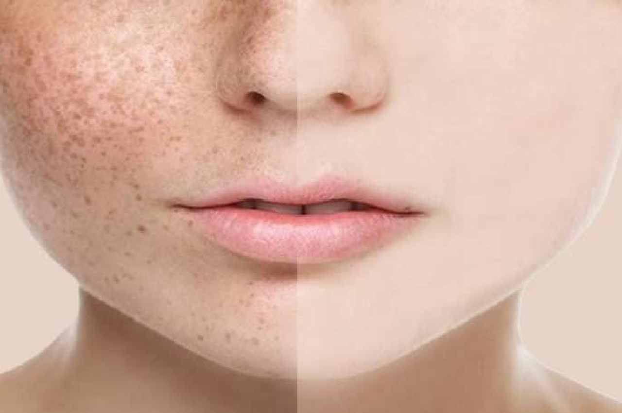 Skin Care TIPS Treatment of wrinkles and freckles