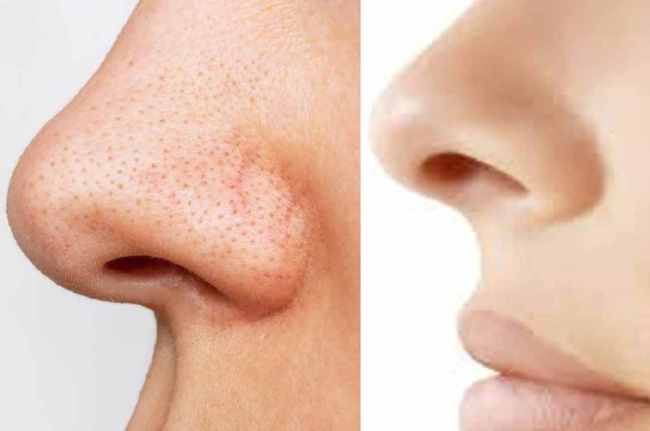 Blackhead Removal Tips