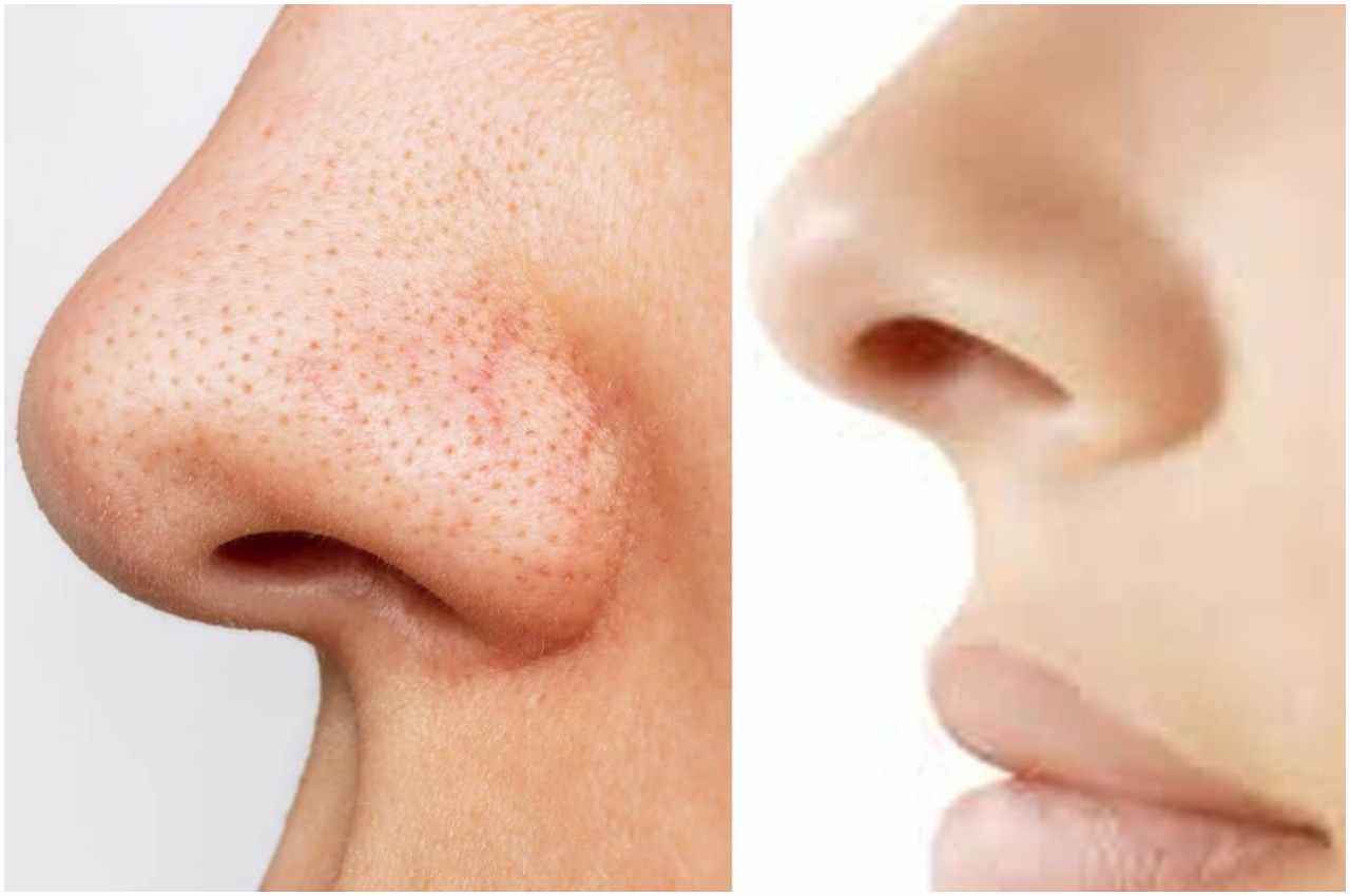 Skin care tips: ब्लैकहेड्स ने कर दिया है परेशान तो फॉलो करें ये टिप्स, तुरंत मिलेगा फायदा
