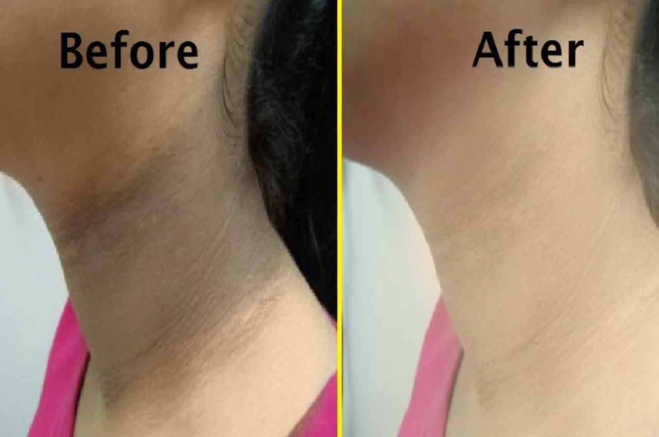 Dark neck Treatment how to remove blackness of neck