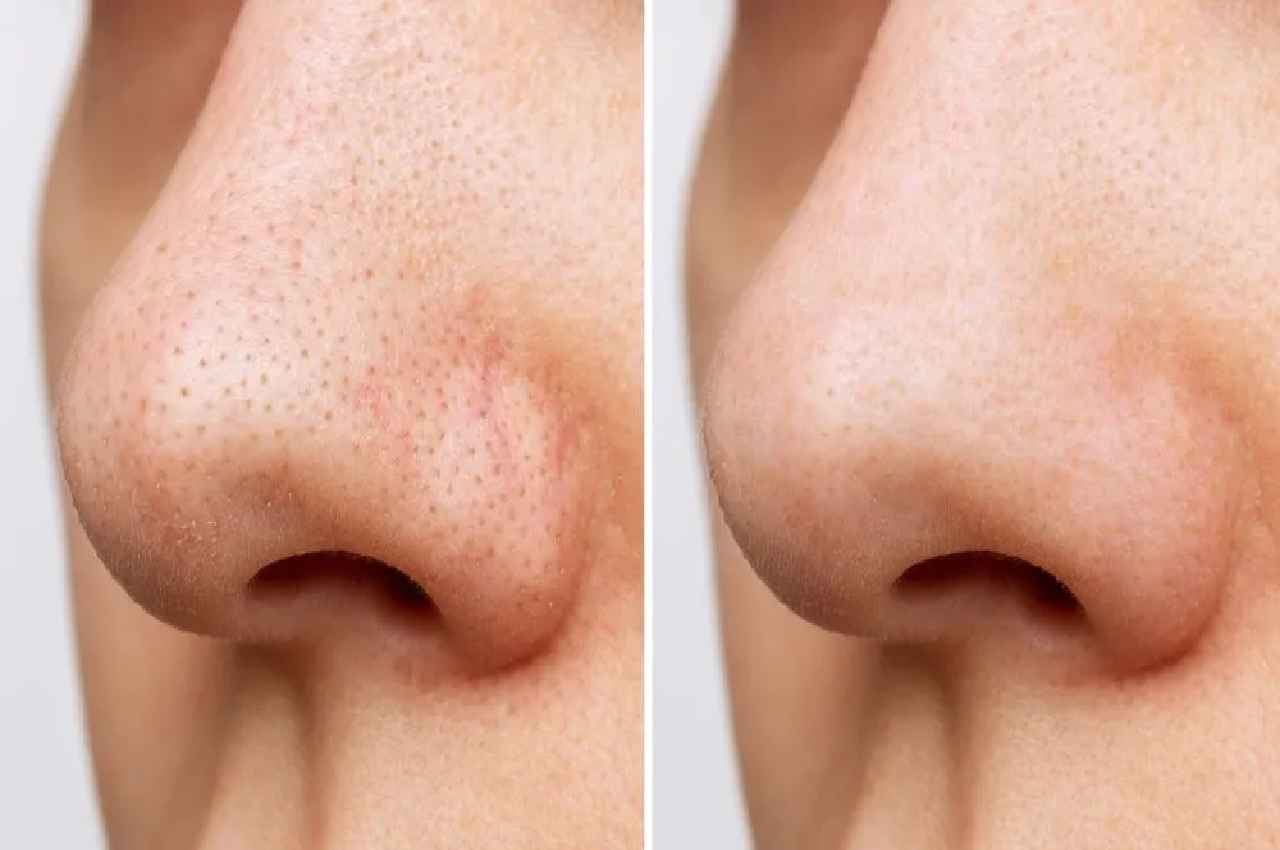Skin care TIPS How to Remove Blackheads