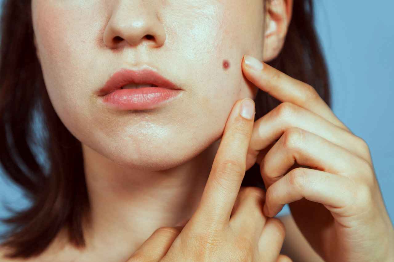 Mole on Body: शरीर में इस जगह है तिल, तो ऐसा व्यक्ति बनता है धनी