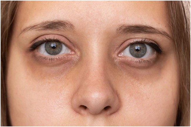 Dark Circle Home Remedies