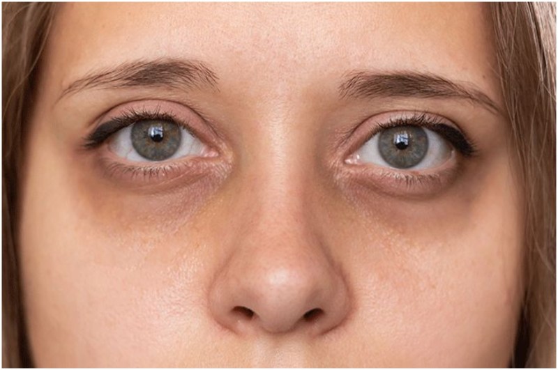 Dark Circle Home Remedies