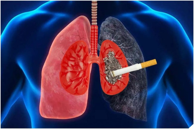 Cancers Associated with Tobacco