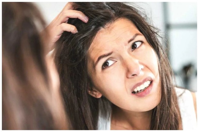 Dandruff Home Remedies