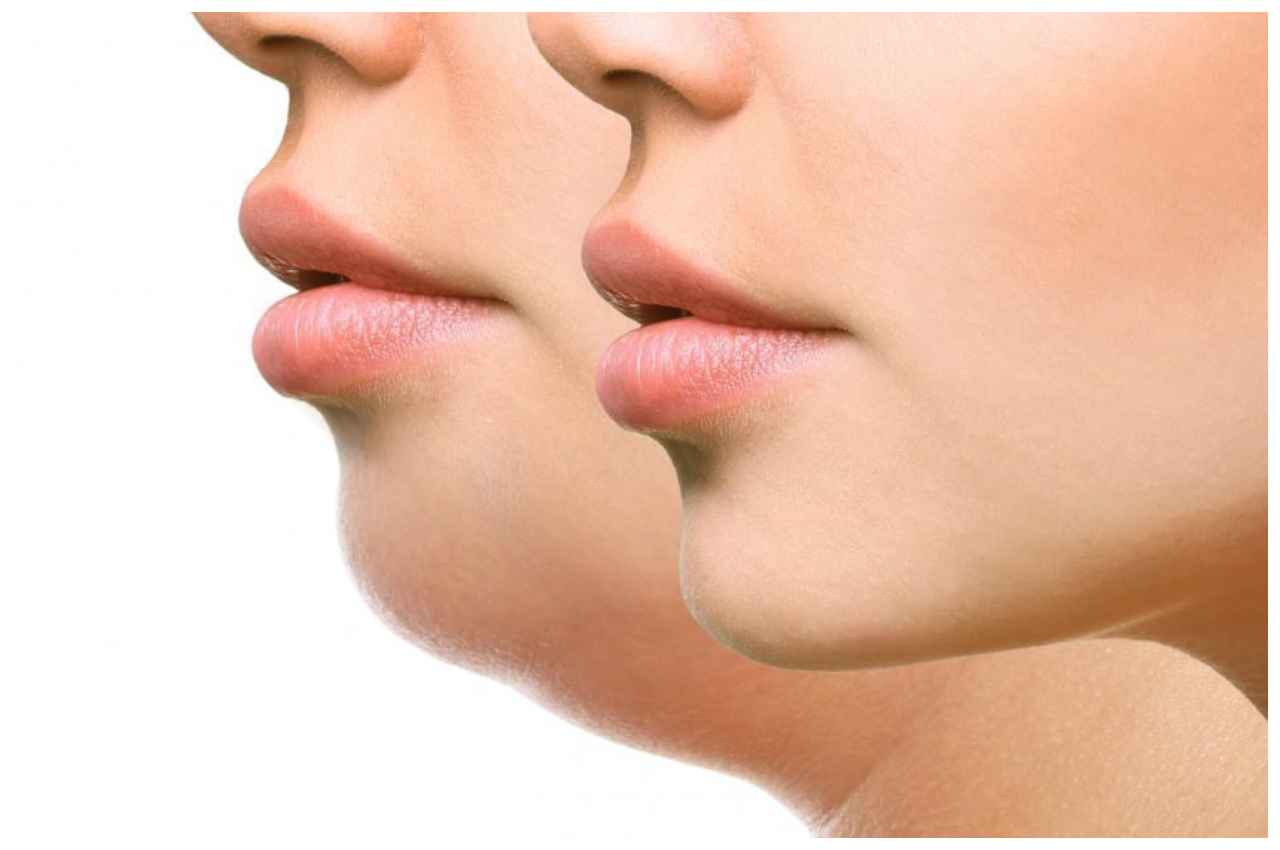 Double Chin: क्या है डबल चिन? जानें इसके कारण