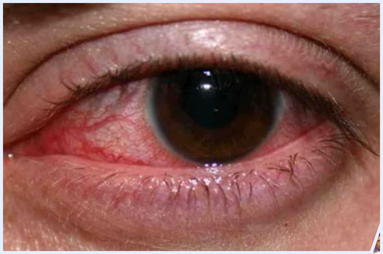 एम्स के Eye Specialist ने दूर किया भ्रम, आईफ्लू वाले की आंख देखने से नहीं फैलता ये वायरस