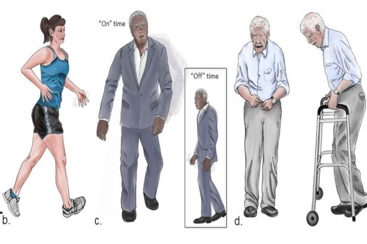 parkinson disease, parkinson, science news, science news hindi, health news