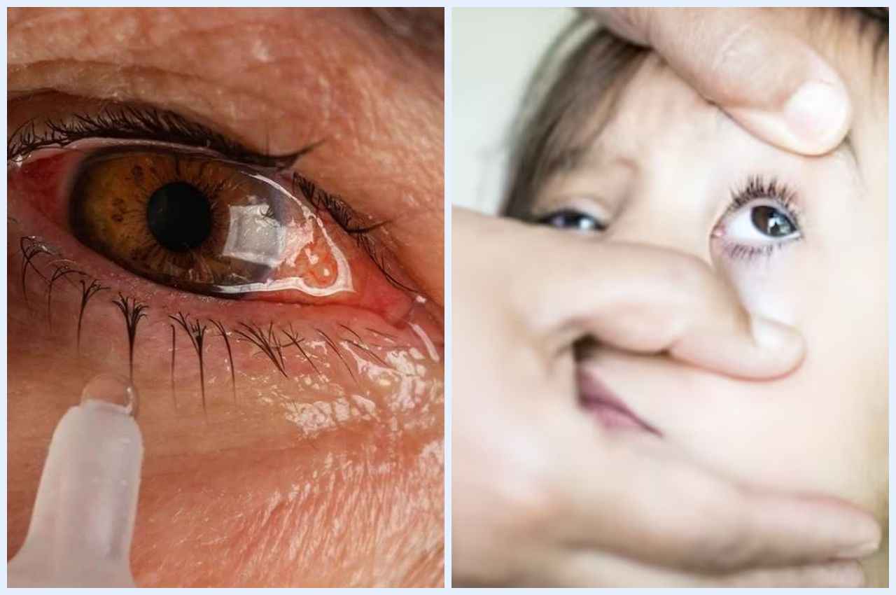 Eye flu: आंखों के वायरस से बच्चों को कैसे बचाएं? डॉक्टर ने बताए 5 आसान टिप्स