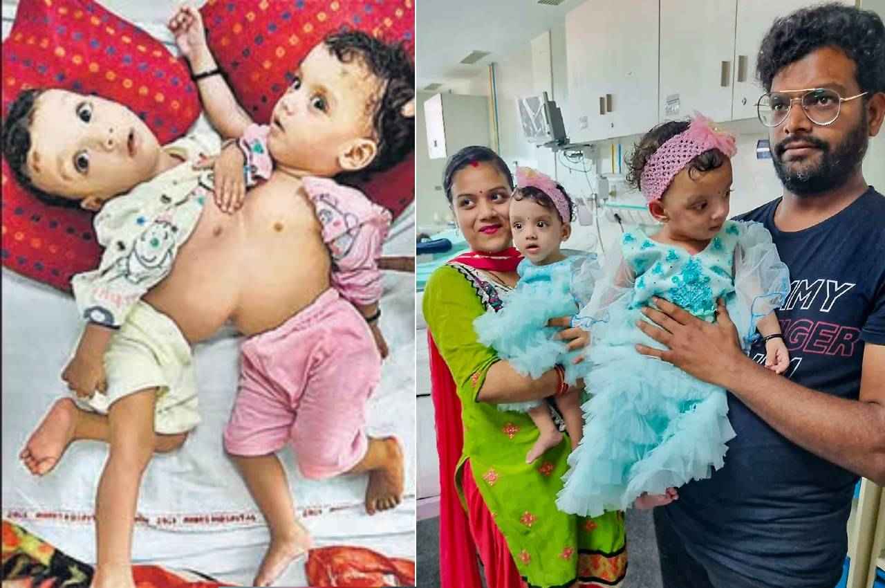 दिल्ली AIMMS के डॉक्टरों का कमाल; छाती और पेट से जुड़ी 1 साल की बच्चियों को किया अलग, 12 घंटे चली सर्जरी