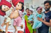 conjoined twins surgery, conjoined twins, twins separated after 12 hour surgery, conjoined twins surgery, delhi aimms, All India Institute of Medical Sciences