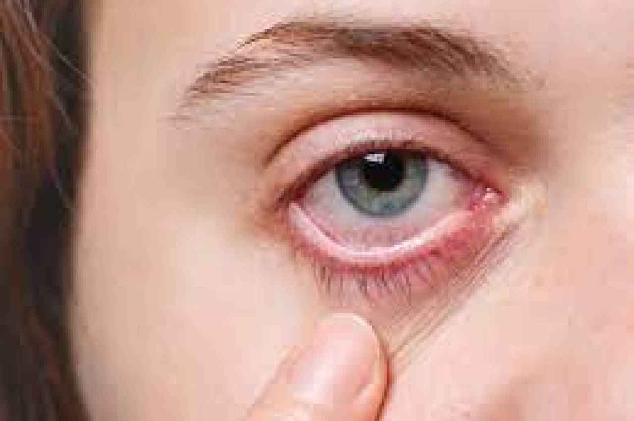 MP में Eye Flu का कहर, हर दिन बढ़ रही मरीजों की संख्या, ऐसे करें बचाव