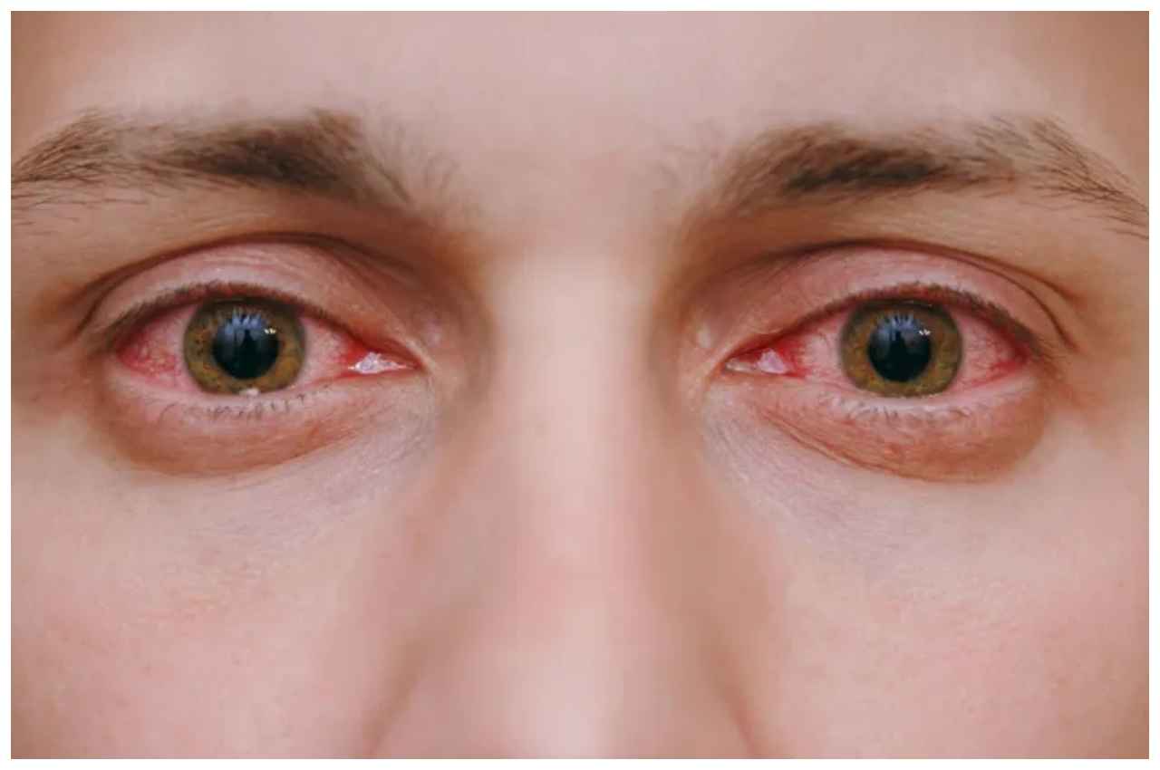 Eye Flu: आई फ्लू से बचाव के लिए अपनाएं ये घरेलू उपाय, जलन और दर्द से मिलेगी राहत