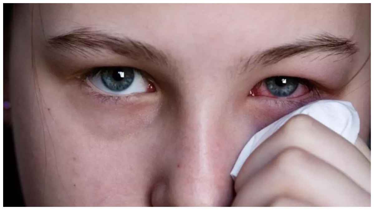 Eye Flu Precautions: अगर हो गया है आई फ्लू तो भूलकर भी नहीं करें ये गलतियां, नहीं तो भुगतने पड़ सकते हैं गंभीर परिणाम