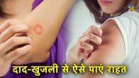 Ringworm Itching, ringworm home remedies, Skin Problems