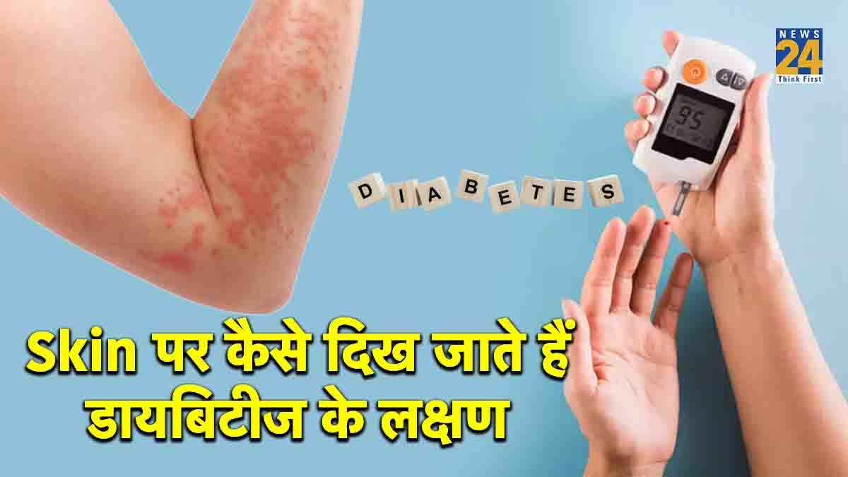 diabetic skin problem diabetic skin conditions,diabetic dermopathy,diabetic legs pictures,early stage diabetes itchy skin,how to treat diabetic skin,diabetes itching skin treatment,type two diabetes skin problems,diabetic skin conditions pictures,diabetic dermopathy,diabetes skin rash,diabetic boils pictures,diabetic blisters