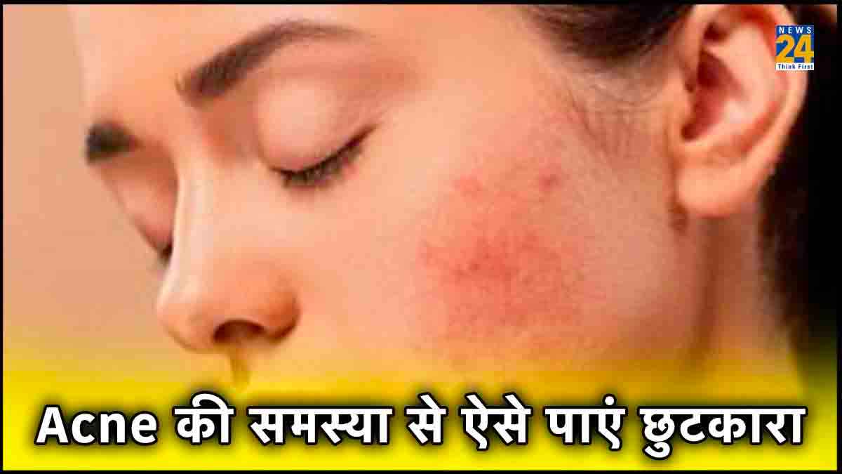 Anti-Acne Diet: चाहिए बेदाग त्वचा? तो अपनी डाइट में शामिल करें ये 5 फूड आइटम्स