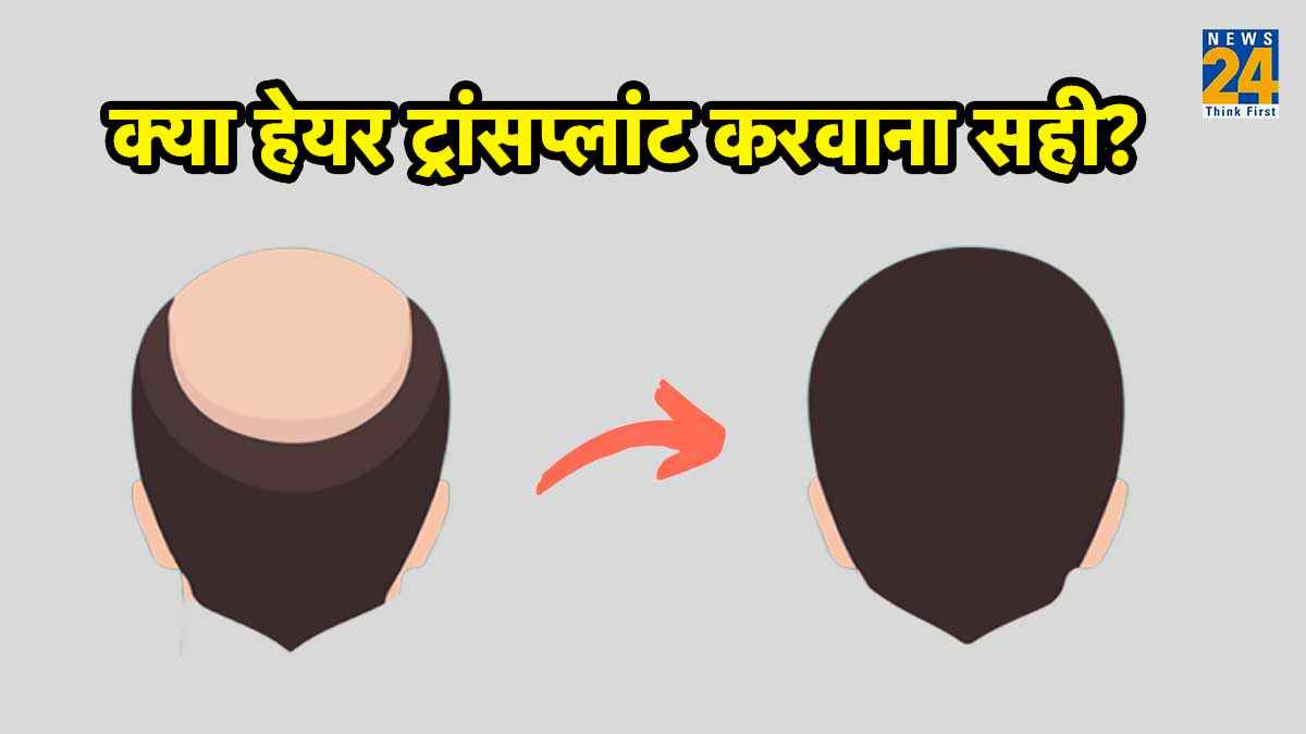 Hair Transplant: हेयर ट्रांसप्लांट कराने से पहले जान लें ये 6 जरूरी बातें, आएंगी बहुत काम