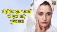skin care, skin care tips, pimple free skin, gharelu upay, home remedies, lifestyle, beauty, beauty tips, natural remedies, gharelu upay