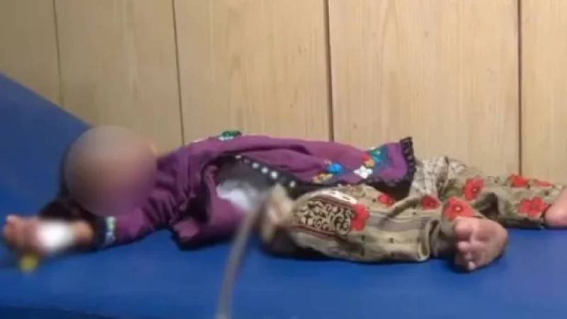 Twin Inside Baby Stomach In Pakistan
