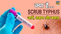 Scrub Typhus Symptoms High Fever Headache