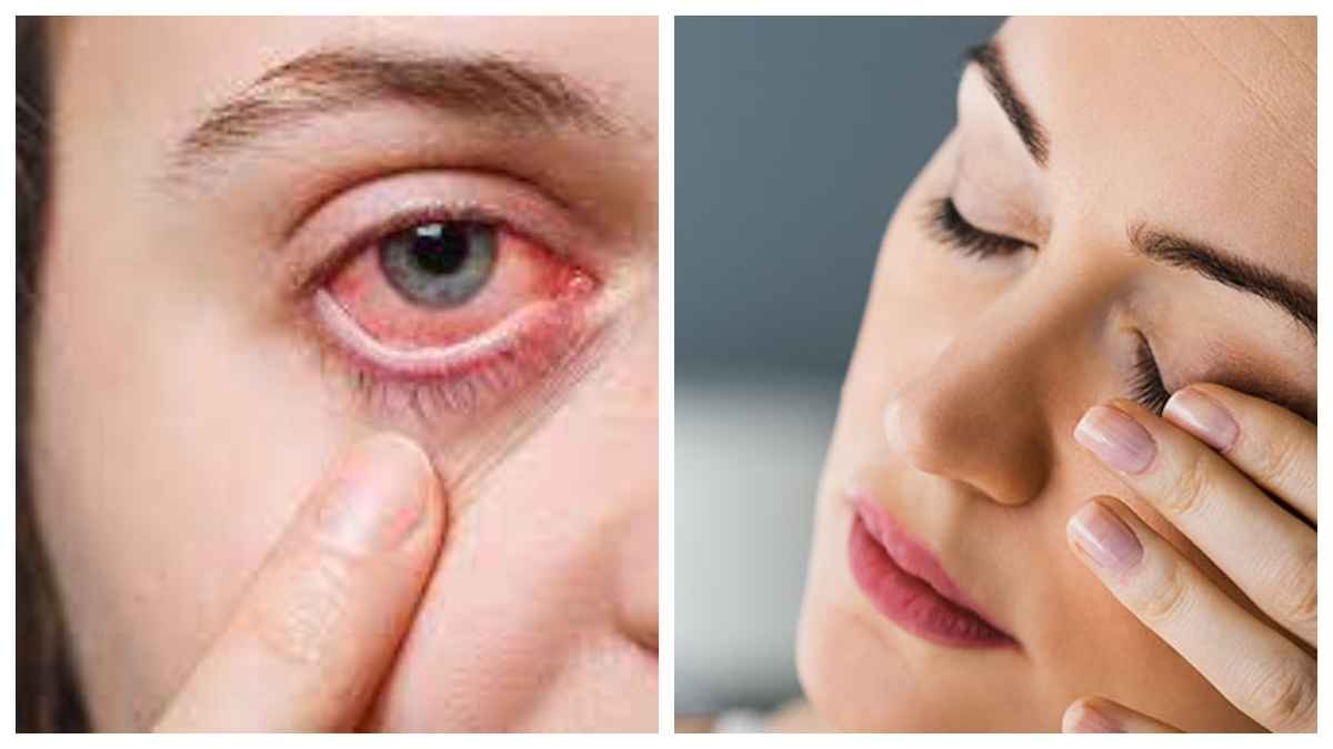 EyeTwitching: क्यों फड़कती हैं आंखें? इनके 4 कारण