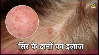 Hair Scalp Acne Bacterial