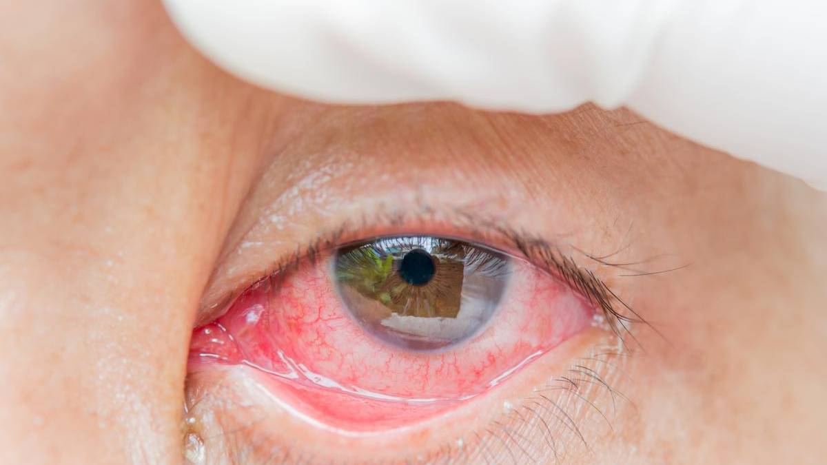 Eye bleeding virus found in FRANCE