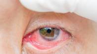 Eye bleeding virus found in FRANCE