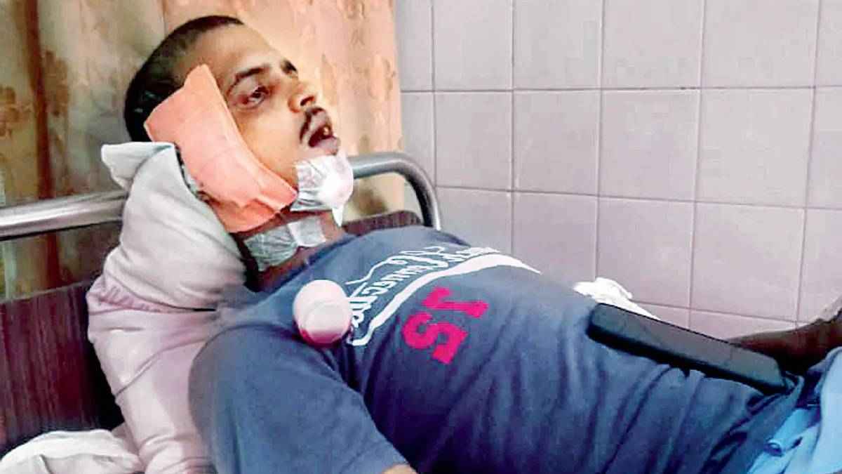 बिल्डिंग के दूसरे फ्लोर से गिरा 'स्पाइडर मैन' चोर, दो दांत टूटकर गिरे; 400 अस्पताल खंगालने के बाद पुलिस ने दबोचा