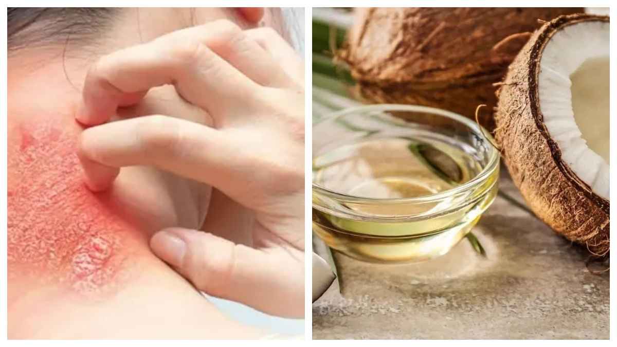 Beauty Tips: रैशेज और इचिंग से परेशान, इन 3 नेचुरल टिप्स से पाए आराम