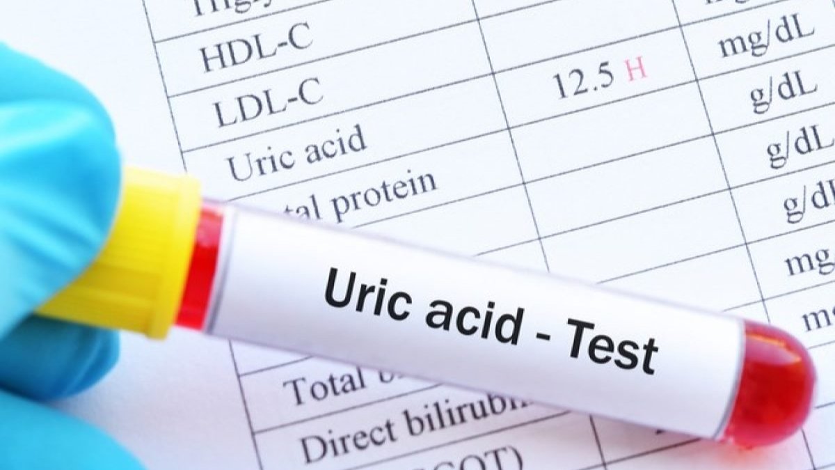 uric acid treatment,uric acid symptoms,how to reduce uric acid,high uric acid symptoms in females,uric acid causes food,uric acid normal range,uric acid symptoms and cure,what level of uric acid is dangerous,how to use papaya for uric acid,how to cure uric acid permanently,uric acid fruits to avoid,is banana good for uric acid,food to reduce uric acid