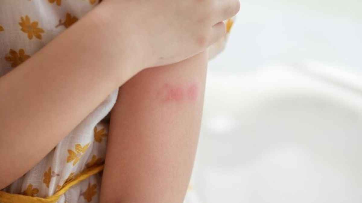 alert measles outbreak 2023,measles treatment for child,measles rash pictures how long does measles last,measles symptoms,can you still get measles after vaccination measles vaccine,measles incubation period