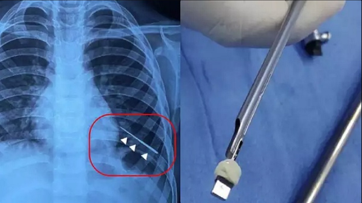 Doctors Removed Sewing Needle From Lung