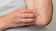 types of fungal infections with pictures skin fungal infection pictures fungal infection on skin what causes fungal infection in private parts what kills a fungal infection skin fungal infection treatment fungal infection medication