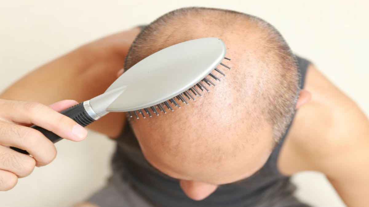 गंजेपन से क्या आप भी हैं परेशान? तो करें ये 3 काम