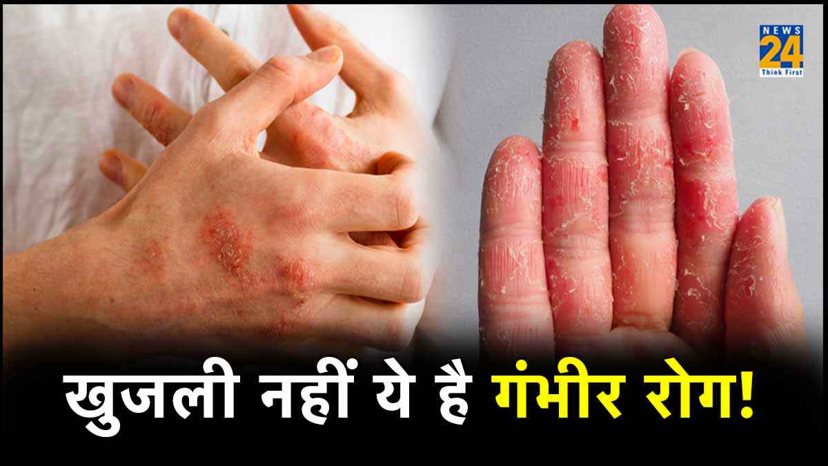 Eczema को खुजली की समस्या समझना सही? जानिए अंतर, प्रकार और इलाज