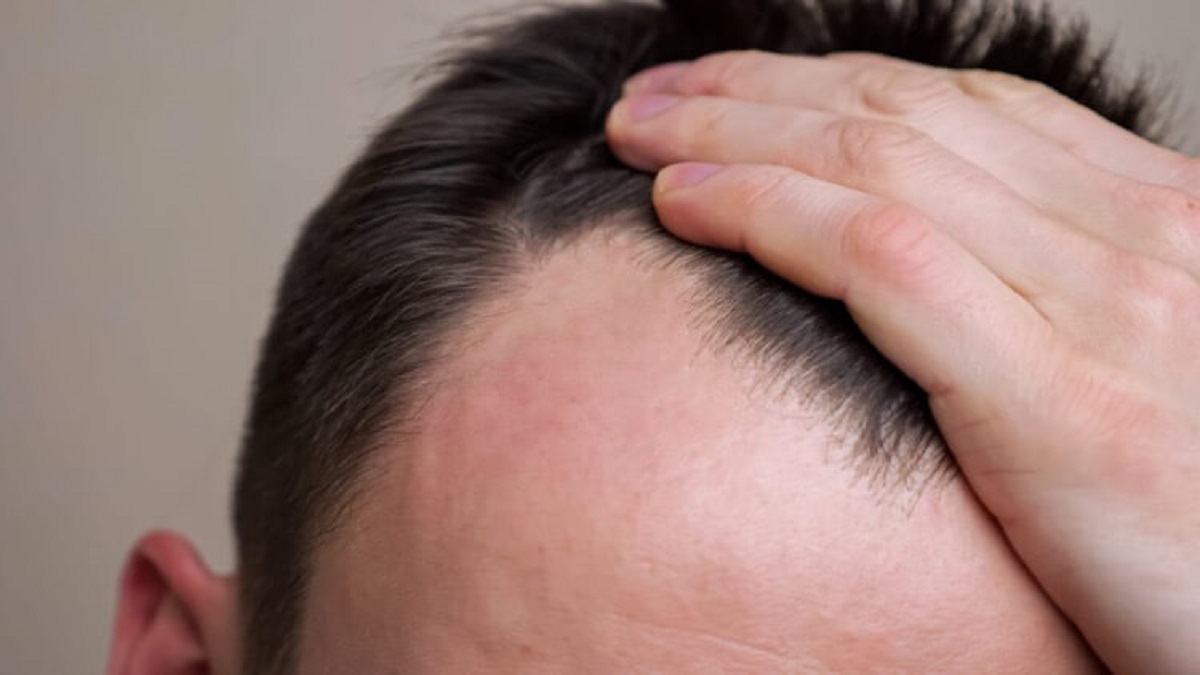 Baldness Treatment