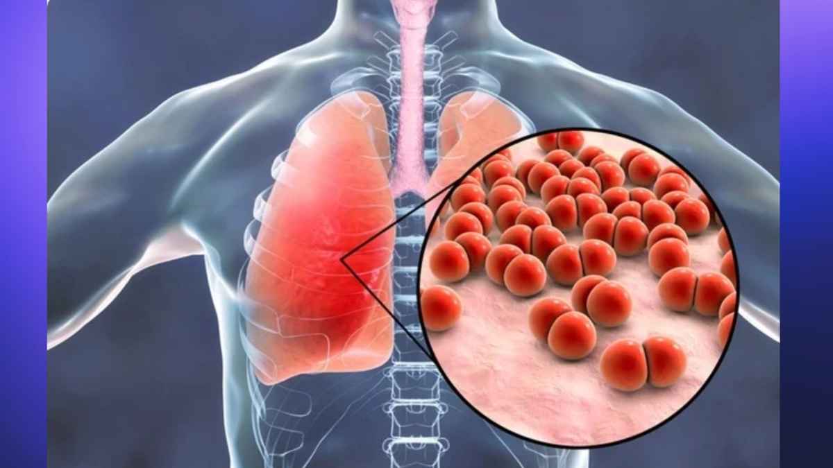 pneumonia