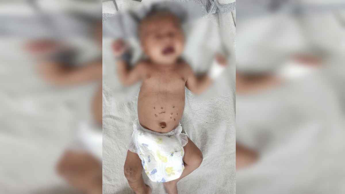 शहडोल में 5 माह के मासूम को 21 बार दागा, जानें क्या है डाॅम प्रथा जिसका शिकार बनते हैं बच्चे