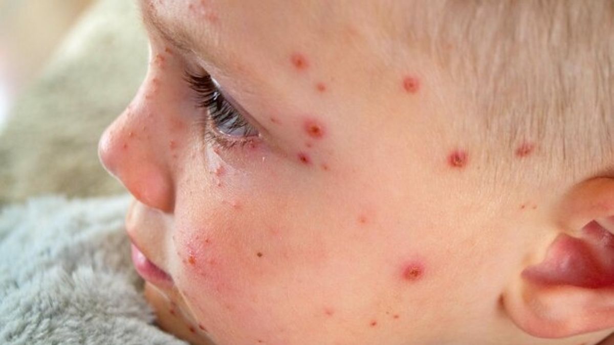 measles in europe 2023 measles outbreak 2023 measles cases worldwide 2023 measles cases in india measles breakthrough cases measles outbreak 2023 uk measles outbreak, france is measles deadly