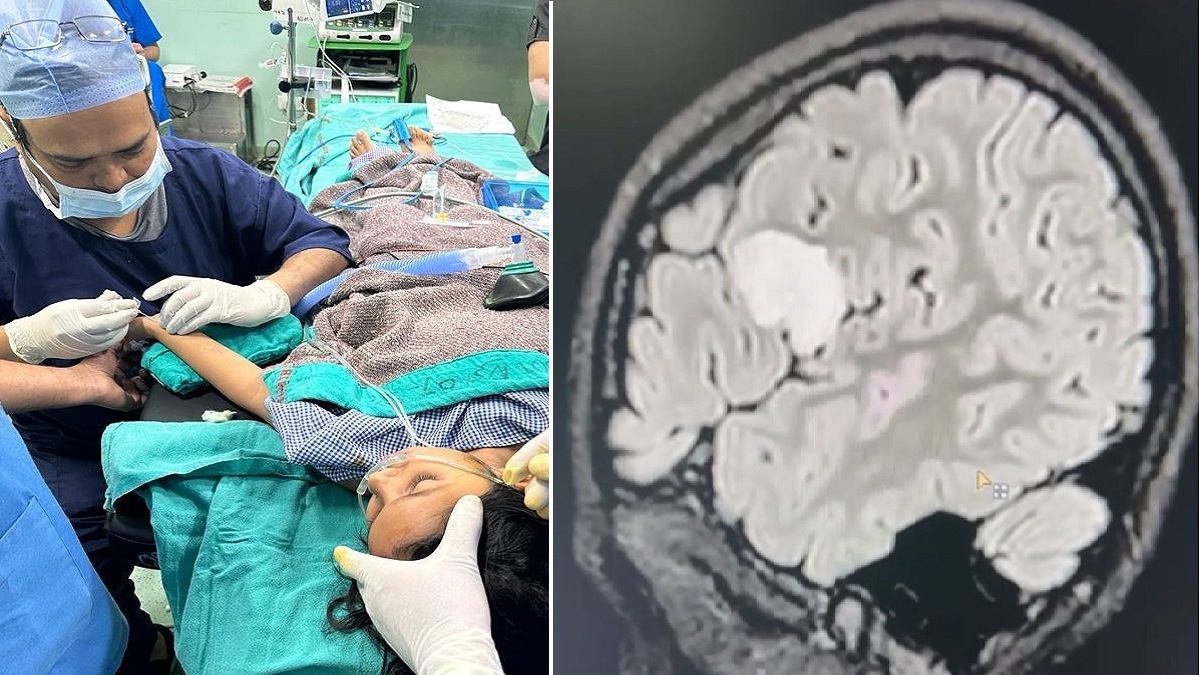 Delhi AIIMS Doctors Conducting Brain Tumor Surgery