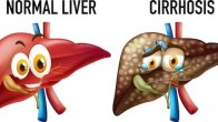 Liver Cirrhosis problems